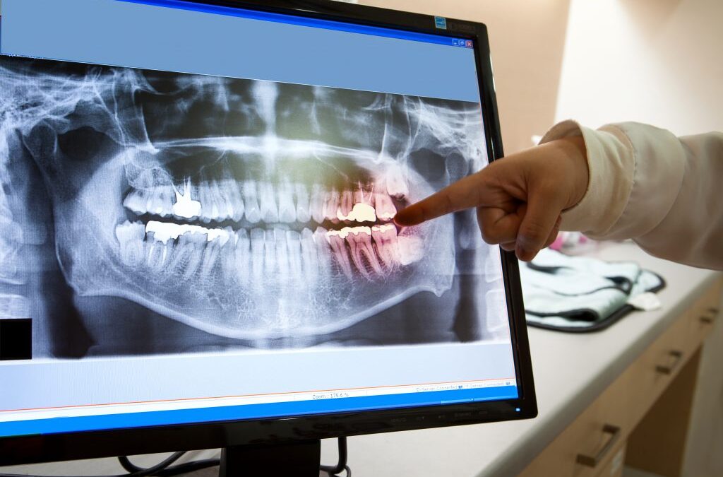 Why Do I Need Dental X-Rays?