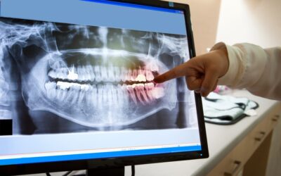Why Do I Need Dental X-Rays?